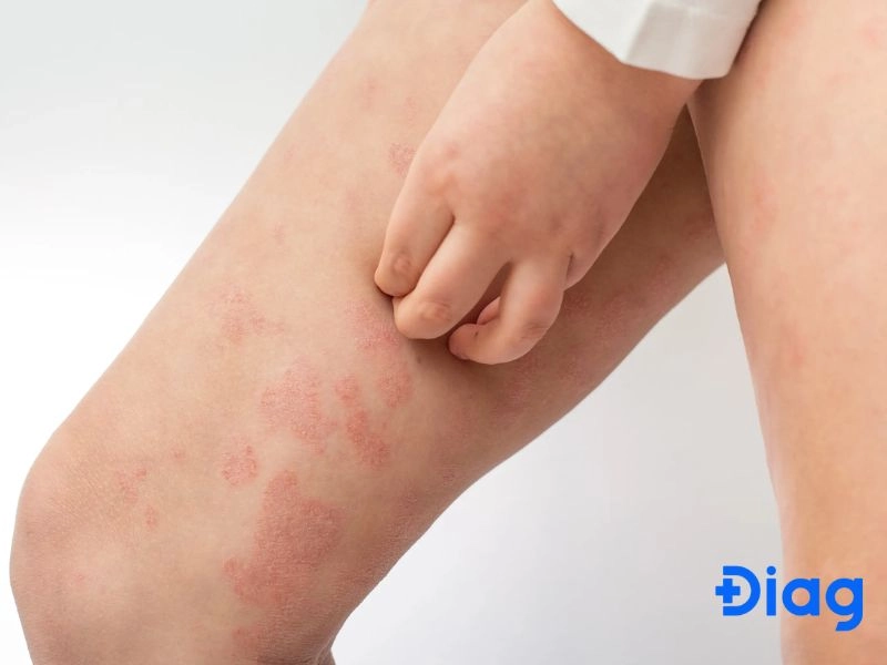 chống dị ứng mạt bụi cho nệm em bé