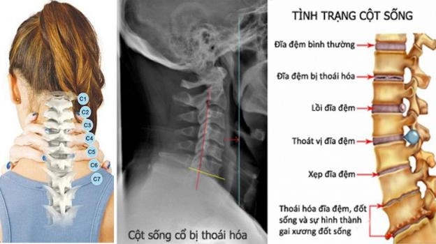 cột sống trung tính trên đệm foam độ cứng vừa